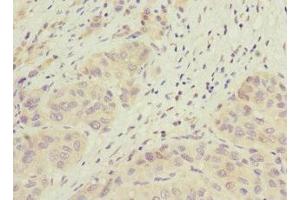 Immunohistochemistry of paraffin-embedded human liver cancer using ABIN7165663 at dilution of 1:100