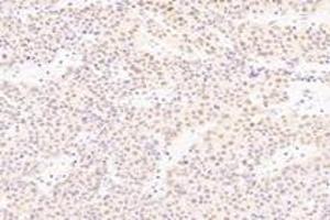Immunohistochemistry analysis of paraffin-embedded human liver cancer using SRFBP1 (ABIN7075579) at dilution of 1: 2000