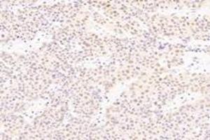 Immunohistochemistry analysis of paraffin-embedded human liver cancer using SRFBP1 (ABIN7075579) at dilution of 1: 2000 (SRFBP1 anticorps)