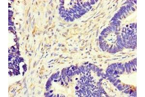 Immunohistochemistry of paraffin-embedded human ovarian cancer using ABIN7149154 at dilution of 1:100