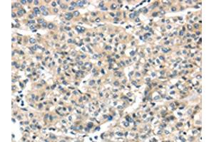 The image on the left is immunohistochemistry of paraffin-embedded Human liver cancer tissue using ABIN7128031(THAP2 Antibody) at dilution 1/20, on the right is treated with fusion protein. (THAP2 anticorps)