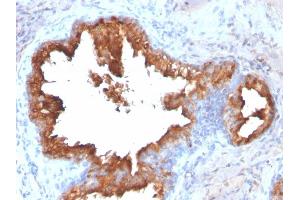 Formalin-fixed, paraffin-embedded human Prostate Carcinoma stained with PSA Rabbit Recombinant Monoclonal Antibody (KLK3/2871R). (Recombinant Prostate Specific Antigen anticorps)