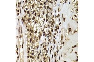 Immunohistochemistry of paraffin-embedded human kidney cancer using ACTL6B antibody (ABIN5974275) at dilution of 1/100 (40x lens).