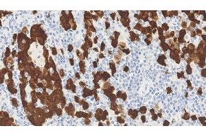 Anaplastic large cell lymphoma: immunohistochemical staining for ALK. (P80 (C-Term), (Catalytic Domain) anticorps)