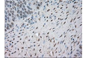 Immunohistochemical staining of paraffin-embedded Adenocarcinoma of colon tissue using anti-NAT8mouse monoclonal antibody. (NAT8 anticorps)