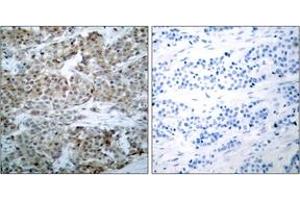 Immunohistochemistry analysis of paraffin-embedded human breast carcinoma, using BAD (Phospho-Ser112) Antibody.