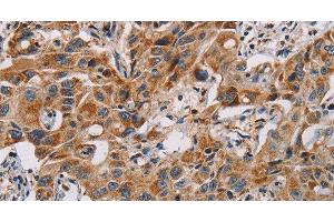 Immunohistochemistry of paraffin-embedded Human lung cancer using MMP1 Polyclonal Antibody at dilution of 1:60 (MMP1 anticorps)