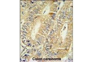 HPGD Antibody (C-term) (ABIN390765 and ABIN2841023) IHC analysis in formalin fixed and paraffin embedded human colon carcinoma followed by peroxidase conjugation of the secondary antibody and DAB staining.