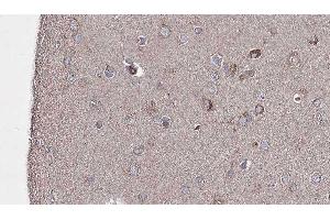ABIN6276691 at 1/100 staining Human brain cancer tissue by IHC-P. (TLR8 anticorps  (C-Term))