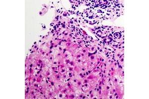 Immunohistochemical analysis of NDUFB9 staining in human liver cancer formalin fixed paraffin embedded tissue section.