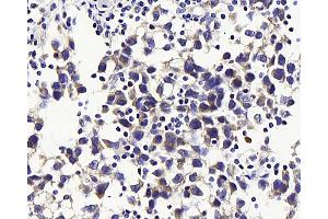 Immunohistochemistry analysis of paraffin-embedded human testis cancer using GLUT-3 Polyclonal Antibody at dilution of 1:300. (SLC2A3 anticorps)