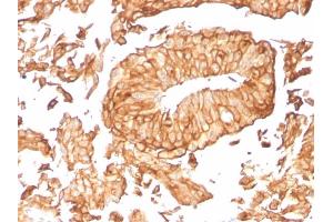 Formalin-fixed, paraffin-embedded human Urothelial Carcinoma stained with Uroplakin 1B Mouse Monoclonal Antibody (UPK1B/3081). (Uroplakin 1B anticorps  (AA 109-229))