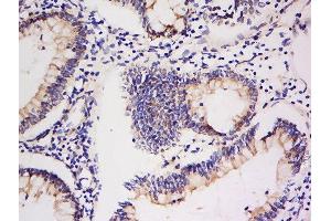Formalin-fixed and paraffin embedded human colon carcinoma labeled with Anti-Integrin Alpha V + Beta 5 Polyclonal Antibody, Unconjugated  at 1:200 followed by conjugation to the secondary antibody and DAB staining. (ITGAV/ITGB5 anticorps)