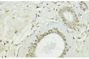 Immunohistochemistry of paraffin-embedded Human breast using Snail Polyclonal Antibody at dilution of 1:100 (40x lens). (SNAIL anticorps)