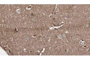 ABIN6279280 at 1/100 staining Human brain cancer tissue by IHC-P.