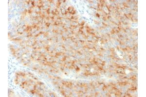 Formalin-fixed, paraffin-embedded human Pancreatic Carcinoma stained with Synaptophysin-Monospecific Mouse Monoclonal Antibody (SYP/3551). (MSH2 anticorps  (AA 224-313))