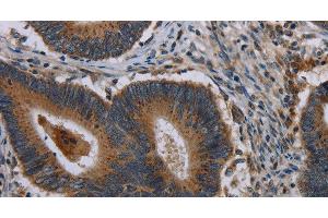 Immunohistochemistry of paraffin-embedded Human colon cancer using MAP3K11 Polyclonal Antibody at dilution of 1:40 (MAP3K11 anticorps)