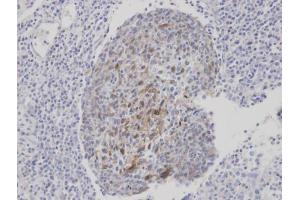 IHC-P Image Immunohistochemical analysis of paraffin-embedded human gastric cancer, using CLCA1, antibody at 1:100 dilution. (CLCA1 anticorps)