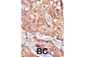 Formalin-fixed and paraffin-embedded human cancer tissue reacted with TRPM6 polyclonal antibody  , which was peroxidase-conjugated to the secondary antibody, followed by AEC staining. (TRPM6 anticorps  (Internal Region))