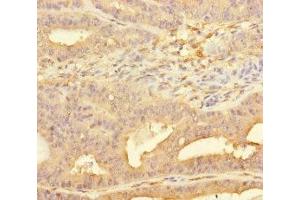Immunohistochemistry of paraffin-embedded human endometrial cancer using ABIN7158455 at dilution of 1:100 (PPFIA1 anticorps  (AA 660-800))