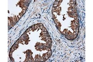 Immunohistochemical staining of paraffin-embedded Adenocarcinoma of ovary tissue using anti-RC201933 mouse monoclonal antibody. (PIM2 anticorps)