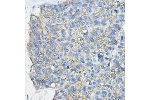 Immunohistochemistry of paraffin-embedded human lung cancer using CD46 Rabbit pAb (ABIN3022325, ABIN3022326, ABIN1512715, ABIN1513898 and ABIN6218741) at dilution of 1:100 (40x lens).