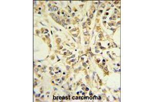 RPS13 Antibody IHC analysis in formalin fixed and paraffin embedded breast carcinoma followed by peroxidase conjugation of the secondary antibody and DAB staining. (RPS13 anticorps  (AA 82-110))