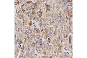 Immunohistochemistry of paraffin-embedded human liver cancer using GAS2 antibody (ABIN5970514) at dilution of 1/200 (40x lens).
