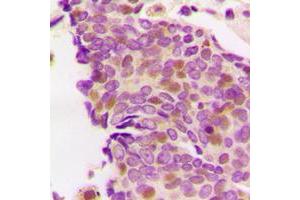 Immunohistochemical analysis of PS1D staining in human breast cancer formalin fixed paraffin embedded tissue section.