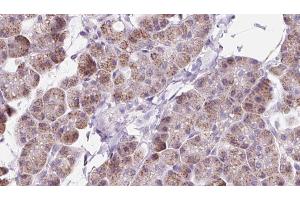 ABIN6273224 at 1/100 staining Human pancreas cancer tissue by IHC-P. (DAAM1 anticorps  (Internal Region))