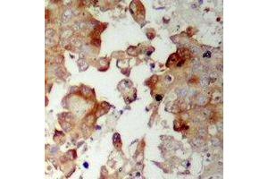 Immunohistochemical analysis of MRPS17 staining in human prostate cancer formalin fixed paraffin embedded tissue section. (MRPS17 anticorps  (N-Term))