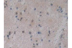 Detection of IGFBP1 in Human Glioma Tissue using Polyclonal Antibody to Insulin Like Growth Factor Binding Protein 1 (IGFBP1) (IGFBPI anticorps  (AA 36-235))