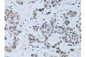 Immunohistochemistry of paraffin-embedded human liver cancer using SIN3A antibody. (SIN3A anticorps)