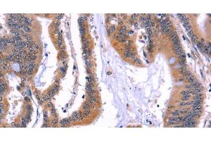 Immunohistochemistry of paraffin-embedded Human colon cancer using ARC Polyclonal Antibody at dilution of 1:50 (ARC anticorps)