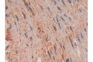 Detection of FADD in Human Stomach cancer Tissue using Polyclonal Antibody to Fas Associating Death Domain Containing Protein (FADD)