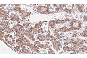ABIN6272676 at 1/100 staining Human liver cancer tissue by IHC-P. (BAI3 anticorps  (Internal Region))