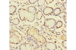 Immunohistochemistry of paraffin-embedded human gastric cancer using ABIN7145609 at dilution of 1:100 (Pallidin anticorps  (AA 1-170))