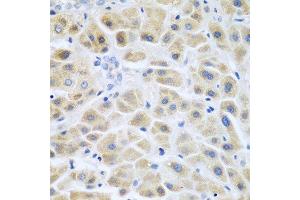 Immunohistochemistry of paraffin-embedded human liver cancer using ACCS antibody at dilution of 1:200 (40x lens). (PHACS anticorps)