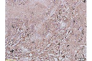 Formalin-fixed and paraffin embedded human lung carcinoma labeled with Anti-EGFR Polyclonal Antibody, Unconjugated (ABIN725720) at 1:200 followed by conjugation to the secondary antibody and DAB staining (EGFR anticorps  (AA 951-1050))