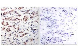 Immunohistochemical analysis of paraffin-embedded human breast carcinoma tissue using STAT5A (phospho-Tyr694) antibody (E011048). (STAT5A anticorps  (pTyr694))