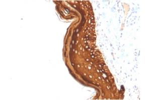 Formalin-fixed, paraffin-embedded human Basal Cell Carcinoma stained with Cytokeratin 15 Mouse Monoclonal Antibody (KRT15/2957).
