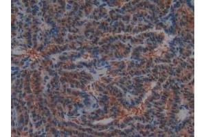 IHC-P analysis of Human Thyroid Cancer Tissue, with DAB staining. (PTF1A anticorps  (AA 177-328))