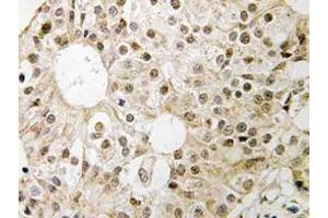 Immunohistochemistry (IHC) analyzes of CD3EAP antibody in paraffin-embedded human breast carcinoma tissue. (CD3EAP anticorps)