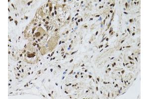 Immunohistochemistry of paraffin-embedded human colon carcinoma using STK11 antibody. (LKB1 anticorps)