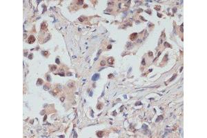 Immunohistochemistry of paraffin-embedded Human lung cancer using TES Polyclonal Antibody at dilution of 1:100 (40x lens). (TES anticorps)