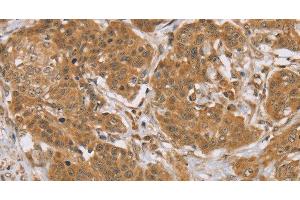 Immunohistochemistry of paraffin-embedded Human cervical cancer tissue using KCNJ15 Polyclonal Antibody at dilution 1:40 (KCNJ15 anticorps)
