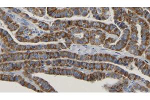 ABIN6267170 at 1/100 staining Human thyroid cancer tissue by IHC-P. (RICTOR anticorps  (pThr1135))