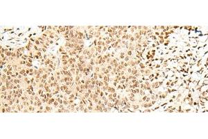 Immunohistochemistry of paraffin-embedded Human ovarian cancer tissue using FKBP5 Polyclonal Antibody at dilution of 1:50(x200)