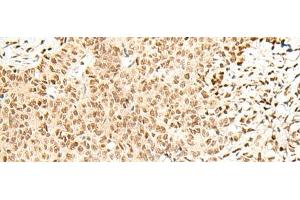 Immunohistochemistry of paraffin-embedded Human ovarian cancer tissue using FKBP5 Polyclonal Antibody at dilution of 1:50(x200) (FKBP5 anticorps)