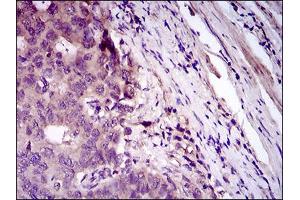 Immunohistochemical analysis of paraffin-embedded esophageal cancer tissues using CD33 mouse mAb with DAB staining.